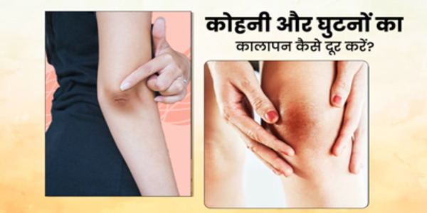 दूर करे घुटने और कोहिनी का कालापन