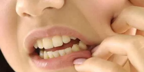 पायरिया पायरिया