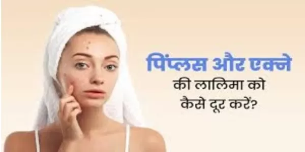पिंपल से हैं परेशान तो अपनाएं ये टिप्स पिंपल से हैं परेशान तो अपनाएं ये टिप्स